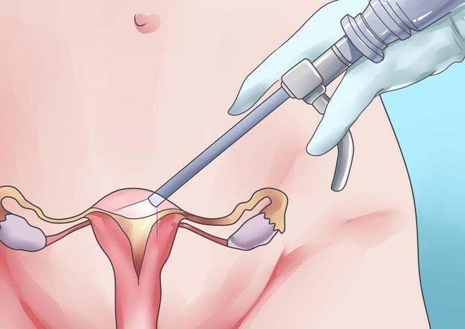 Операция по гинекологии удаления матки